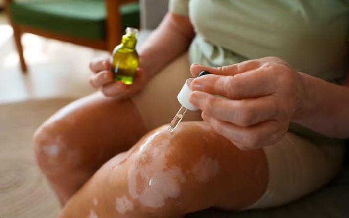 Homeopathy for Skin Disorders in Ashok Vihar